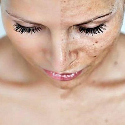 Chemical Peels
