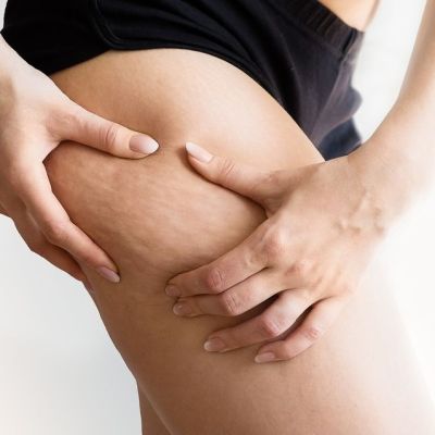 Cellulite Reduction